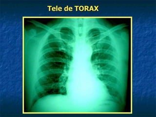 Tele de   TORAX 