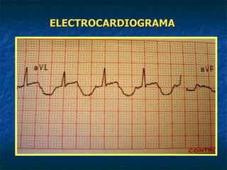 ELECTROCARDIOGRAMA 