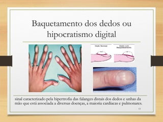 Baquetamento dos dedos ou
hipocratismo digital
13
 