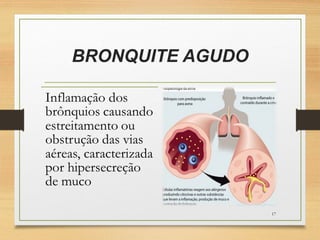 BRONQUITE AGUDO
17
 