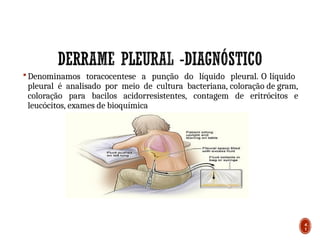  Denominamos toracocentese a punção do líquido pleural. O líquido
pleural é analisado por meio de cultura bacteriana, coloração de gram,
coloração para bacilos acidorresistentes, contagem de eritrócitos e
leucócitos, exames de bioquímica
4
1
 