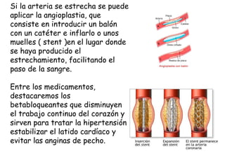 Si la arteria se estrecha se puede aplicar la angioplastia, que consiste en introducir un balón con un catéter e inflarlo o unos muelles ( stent )en el lugar donde se haya producido el estrechamiento, facilitando el paso de la sangre. Entre los medicamentos, destacaremos los betabloqueantes que disminuyen el trabajo continuo del corazón y sirven para tratar la hipertensión, estabilizar el latido cardíaco y evitar las anginas de pecho. 