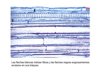 Las flechas blancas indican fibras y las flechas negras engrosamientos
anulares en una tráquea
 