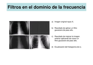 a) Imagen original rayos X.
b) Resultado de aplicar un filtro
gaussiano de paso alto.
Filtros en el dominio de la frecuencia
c) Resultado de mejorar la imagen
anterior aplicando de nuevo un
filtro gaussiano de paso alto.
d) Ecualización del histograma de c).
 