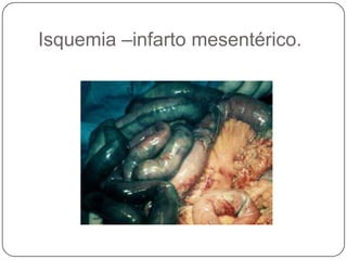 Isquemia –infarto mesentérico.
 