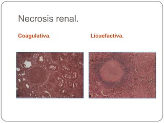 Necrosis renal.
Coagulativa.      Licuefactiva.
 
