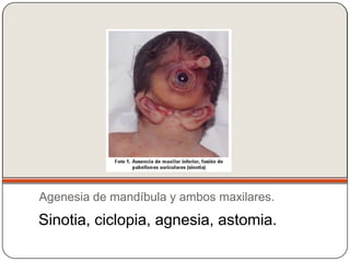 Agenesia de mandíbula y ambos maxilares.
Sinotia, ciclopia, agnesia, astomia.
 