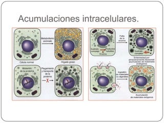 Acumulaciones intracelulares.
 