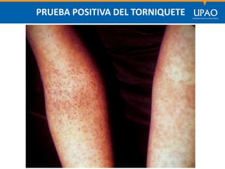 SECCIÓN DE POSTGRADO DE CIENCIAS DE LA COMUNICACIÓN
PRUEBA POSITIVA DEL TORNIQUETE
 