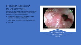 ESOFAGITIS .pptx un reto medico actual que necesita su atencion | PPTX