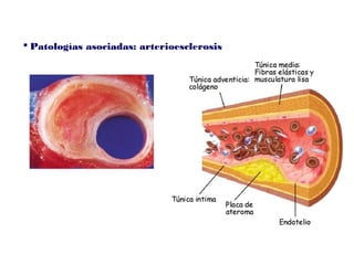  Patologías asociadas: arterioesclerosis
 