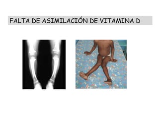 FALTA DE ASIMILACIÓN DE VITAMINA D 