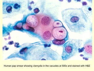 Human pap smear showing clamydia in the vacuoles at 500x and stained with H&E
 