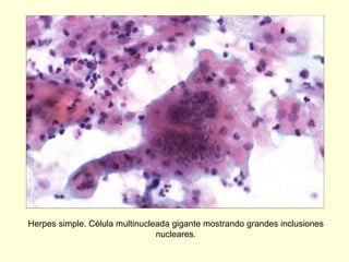 Herpes simple. Célula multinucleada gigante mostrando grandes inclusiones
nucleares.
 