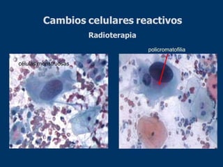 policromatofilia
células monstruosas
 