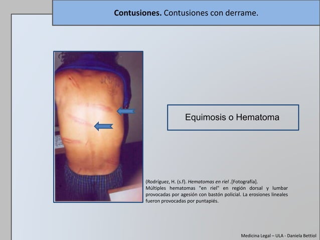 Tema 4. Lesiones. Contusiones. | PPTX