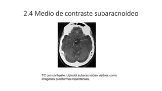 2.4 Medio de contraste subaracnoideo
TC con contraste. Lipiodol subaracnoideo visibles como
imágenes puntiformes hiperdens...