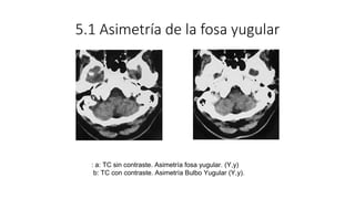 5.1 Asimetría de la fosa yugular
: a: TC sin contraste. Asimetría fosa yugular. (Y,y)
b: TC con contraste. Asimetría Bulbo...