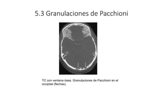 5.3 Granulaciones de Pacchioni
TC con ventana ósea. Granulaciones de Pacchioni en el
occipital (flechas).
 