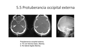 5.5 Protuberancia occipital externa
Protuberancia occipital externa.
a: TC con técnica ósea. (flecha).
b: Rx lateral digit...
