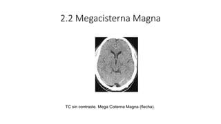 2.2 Megacisterna Magna
TC sin contraste. Mega Cisterna Magna (flecha).
 