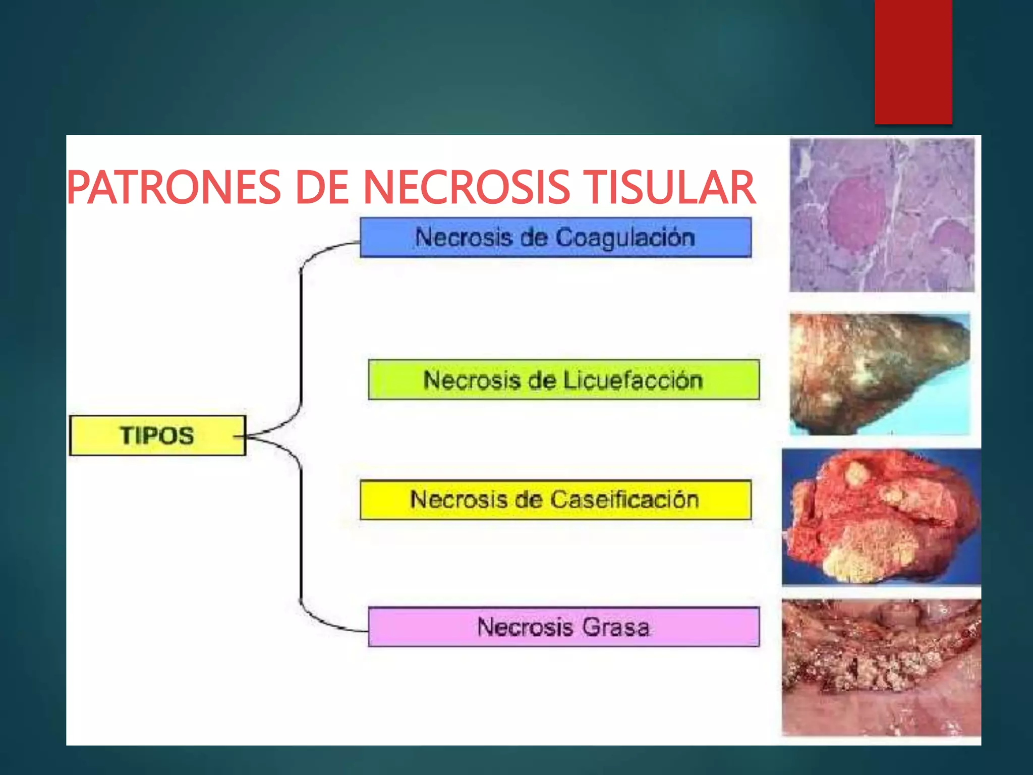 PATRONES DE NECROSIS TISULAR
 