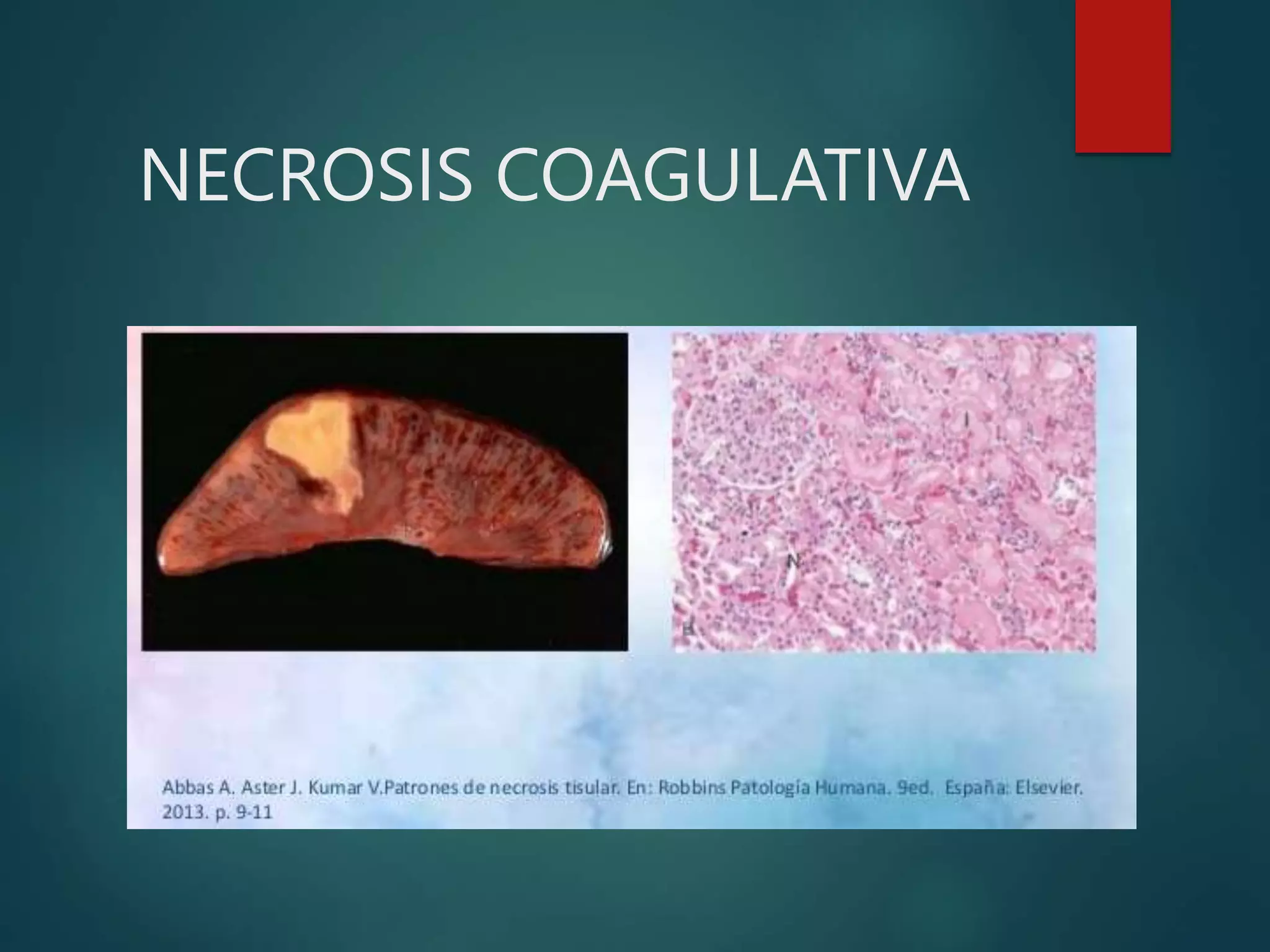 NECROSIS COAGULATIVA
 