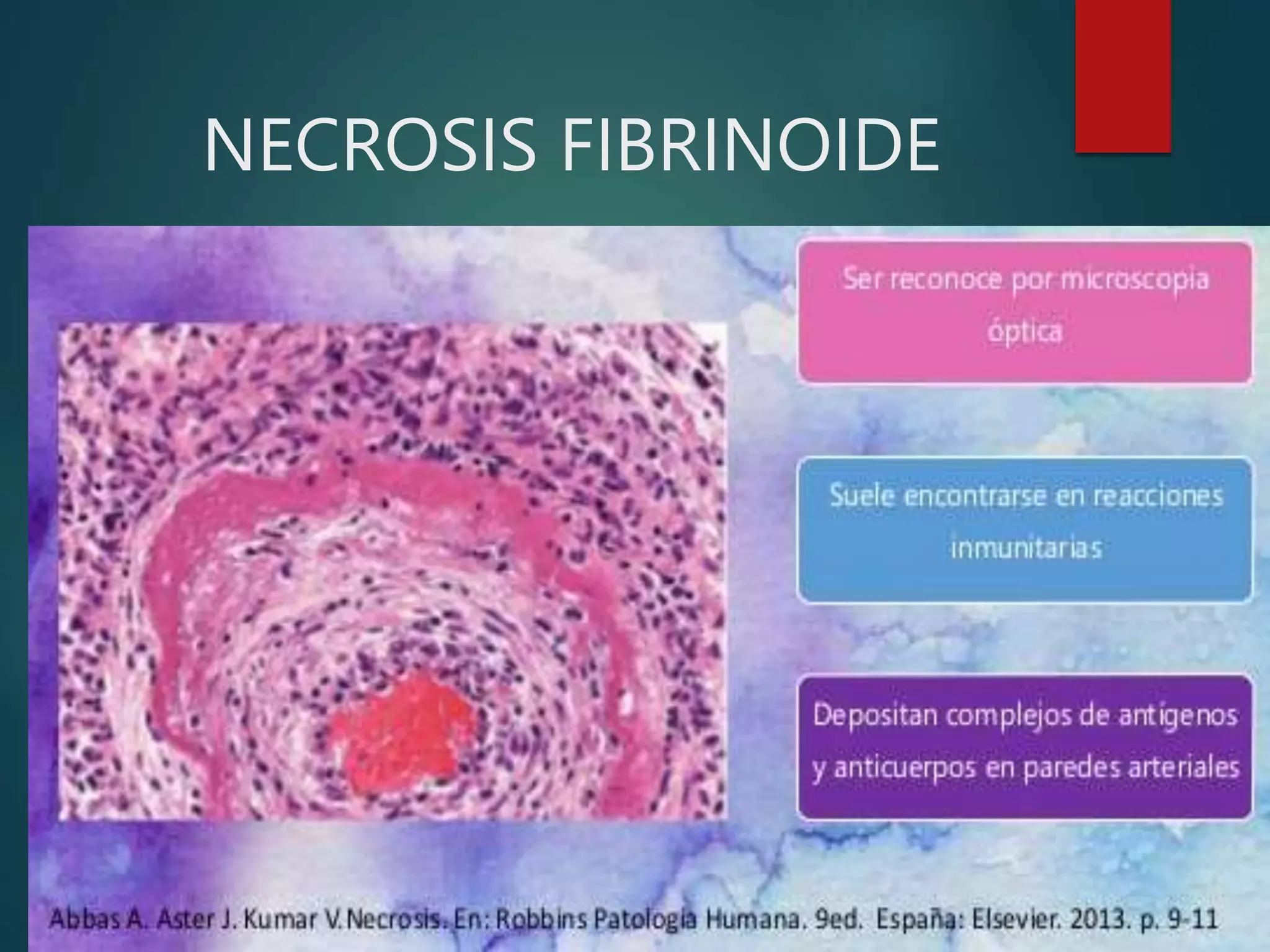 NECROSIS FIBRINOIDE
 