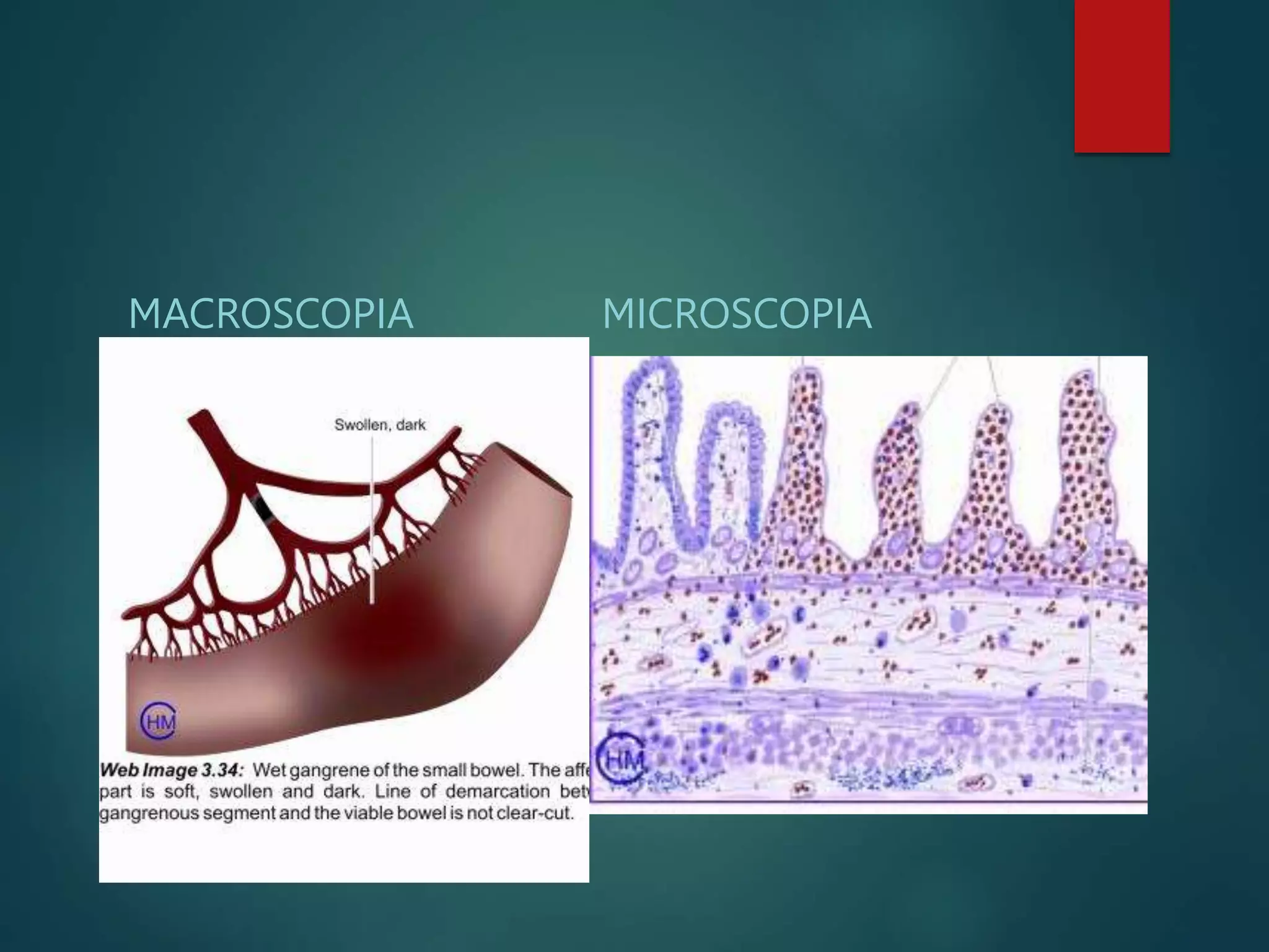 MACROSCOPIA
La parte afectada es
blanda,tumefacta, pútrida y
oscura.
MICROSCOPIA
 Necrosis por coagulación,
con acumulación de sangre
en la parte afectada.
Intensa infiltración
inflamatoria. La línea de
demarcación entre el
segmento gangrenoso y el
viable no es definida
 