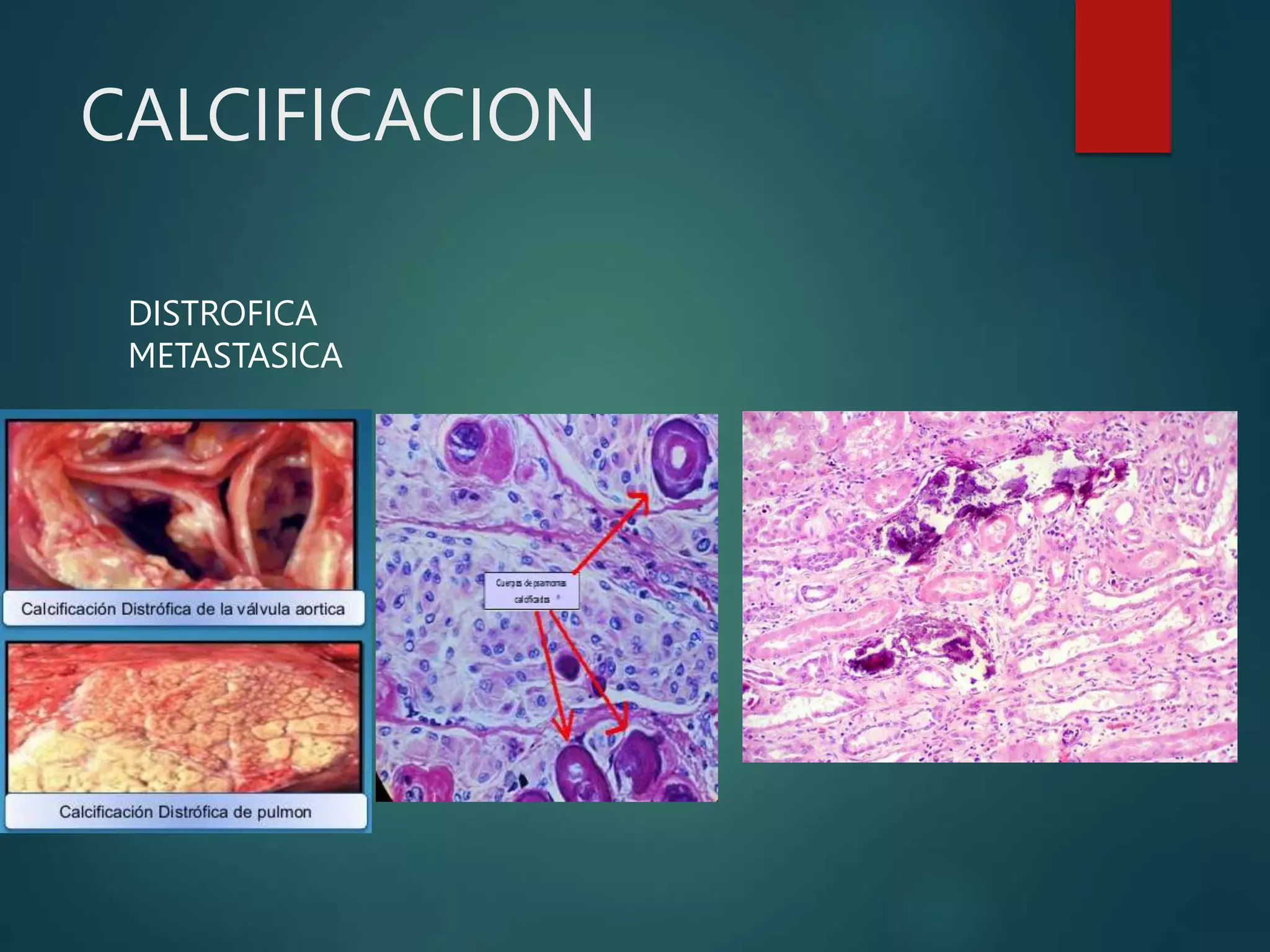 CALCIFICACION
DISTROFICA
METASTASICA
 
