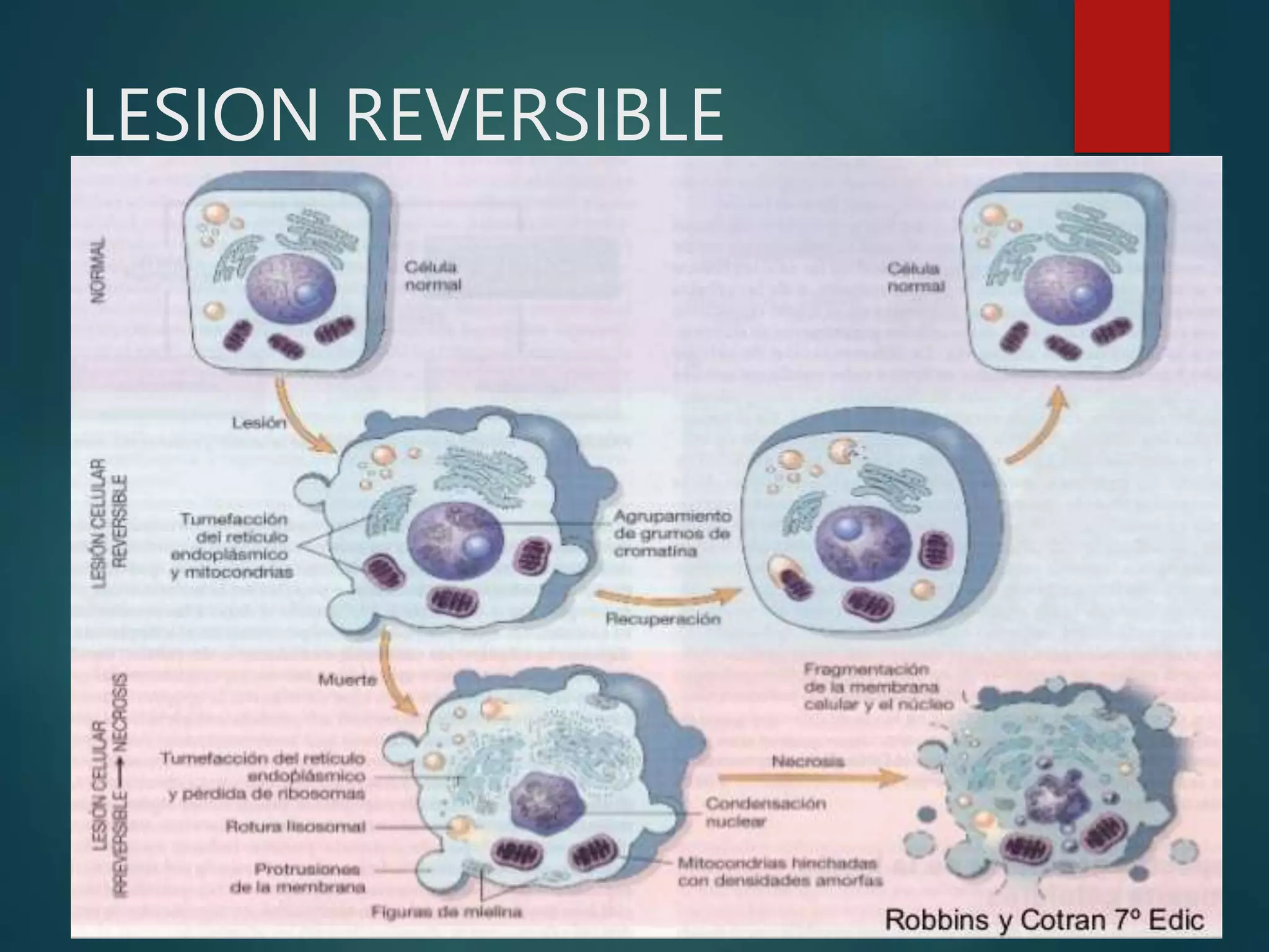 LESION REVERSIBLE
 