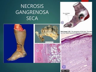 tema-4-degeneracion-y-necrosis-pptx