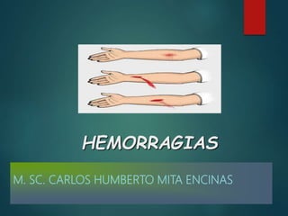 M. SC. CARLOS HUMBERTO MITA ENCINAS
HEMORRAGIAS
 