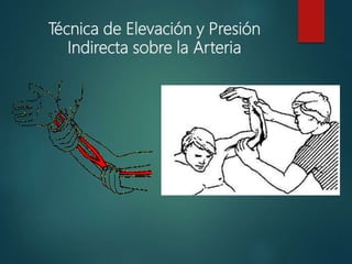 Técnica de Elevación y Presión
Indirecta sobre la Arteria
 