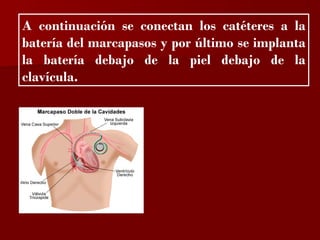?

A continuación se conectan los catéteres a la
batería del marcapasos y por último se implanta
la batería debajo de la piel debajo de la
clavícula.
 