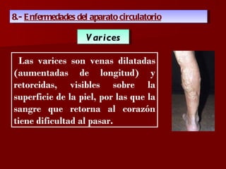 ?

8.- E nfermedades del aparato circulatorio

                    V ar ices

  Las varices son venas dilatadas
(aumentadas de longitud) y
retorcidas, visibles sobre la
superficie de la piel, por las que la
sangre que retorna al corazón
tiene dificultad al pasar.
 