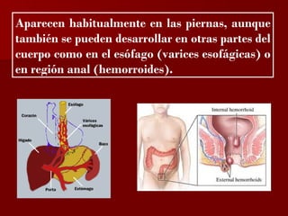 ?

Aparecen habitualmente en las piernas, aunque
también se pueden desarrollar en otras partes del
cuerpo como en el esófago (varices esofágicas) o
en región anal (hemorroides).
 