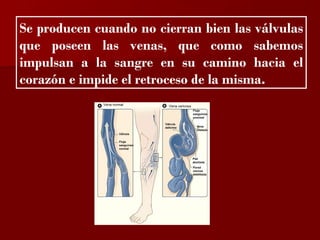 ?

Se producen cuando no cierran bien las válvulas
que poseen las venas, que como sabemos
impulsan a la sangre en su camino hacia el
corazón e impide el retroceso de la misma.
 
