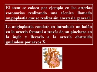 ?

El stent se coloca por ejemplo en las arterias
coronarias realizando una técnica llamada
angioplastia que se realiza sin anestesia general.

La angioplastia consiste en introducir un balón
en la arteria femoral a través de un pinchazo en
la ingle y llevarlo a la arteria obstruida
guiándose por rayos X.
 