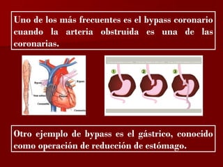 ?

Uno de los más frecuentes es el bypass coronario
cuando la arteria obstruida es una de las
coronarias.




Otro ejemplo de bypass es el gástrico, conocido
como operación de reducción de estómago.
 