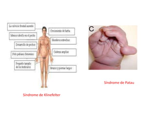 Síndrome de Patau


Síndrome de Klinefelter
 
