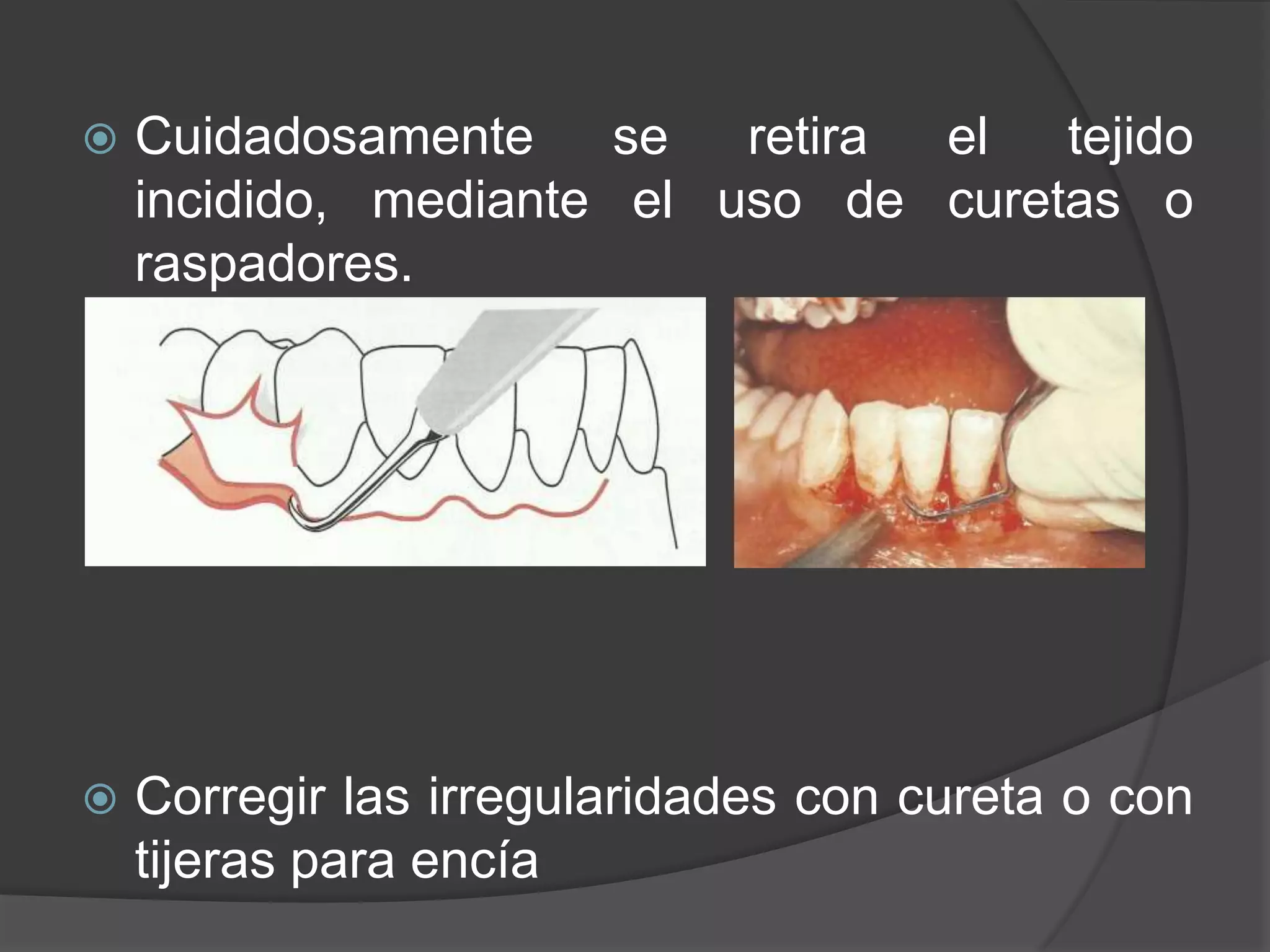 Bisel Gingivectomia A Bisel Externo - Tema 4 | PPTX