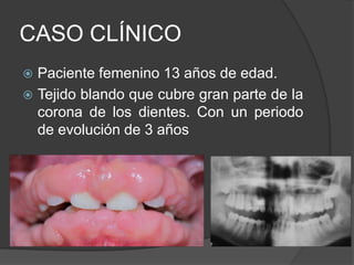 CASO CLÍNICO
 Paciente femenino 13 años de edad.
 Tejido blando que cubre gran parte de la
  corona de los dientes. Con un periodo
  de evolución de 3 años
 