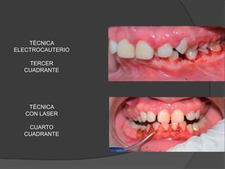 TÉCNICA
ELECTROCAUTERIO

   TERCER
  CUADRANTE




    TÉCNICA
   CON LASER

   CUARTO
  CUADRANTE
 