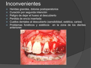 Inconvenientes
   Heridas grandes, dolores postoperatorios
   Curación por segunda intención
   Peligro de dejar el hueso al descubierto
   Perdida de encía insertada
   Cuellos dentales al descubierto (sensibilidad, estética, caries)
   Problemas fonéticos y estéticos en la zona de los dientes
    anteriores
 