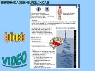 Enfermidades NeurolóxicasEpilepsiaVIDEO
