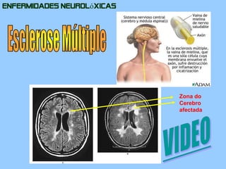 Enfermidades NeurolóxicasEsclerose MúltipleZona do Cerebro afectadaVIDEO