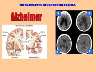 ENFERMIDADES NEURODEXENERATIVAS34Alzheimer12