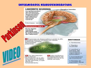 ENFERMIDADES NEURODEXENERATIVASParkinsonVIDEO