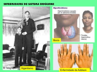 Enfermidades do Sistema EndócrinoBocioXigantismoEnfermidade de Addison